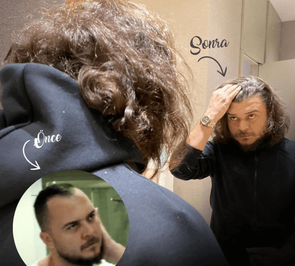 שיער של השתלת שיער לפני ואחרי